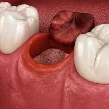 ¿Qué es la alveolitis dental?