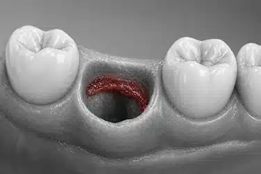 Alvéolo vacío sin coágulo tras extracción dental, signo típico de alveolitis