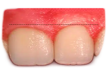 Encía que cubre demasiado el diente y reduce la corona visible