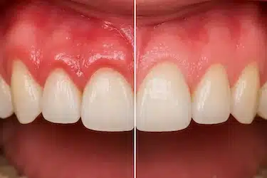 Encía inflamada durante el cepillado dental en la zona anterior