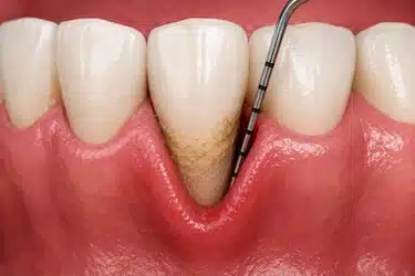 Sonda periodontal valorando una bolsa antes de una gingivectomía