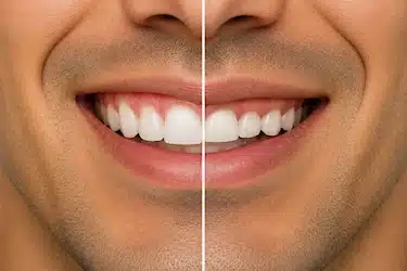Gingivectomía para reducir encía visible y mejorar la proporción dental