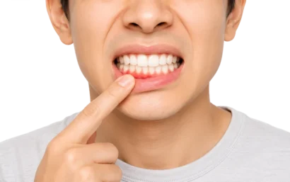 Encías inflamadas y sangrado de encías por gingivitis