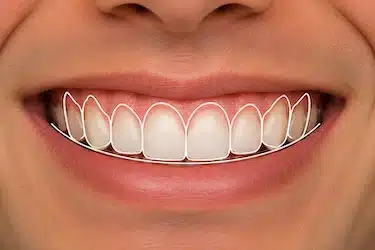 Gingivoplastia para mejorar el contorno de la encía en sonrisa gingival