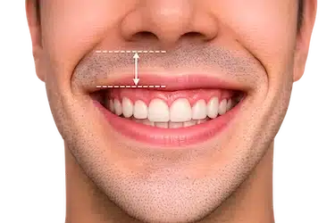 Labio superior que se eleva mucho al sonreír y muestra más encía