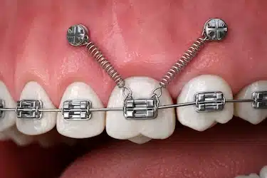 Ortodoncia con microtornillos para ajustar la posición dental vertical