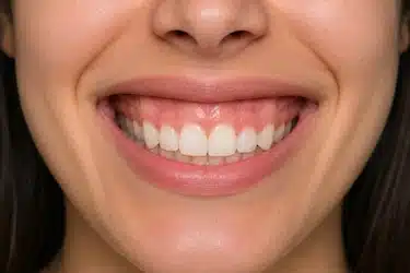 Posición baja de los dientes superiores