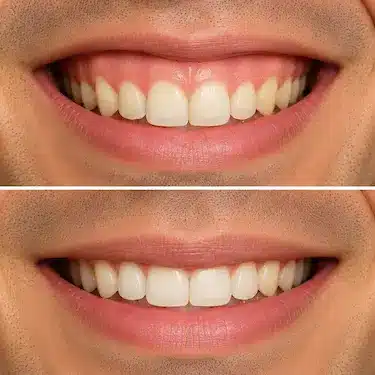 Antes y después de sonrisa gingival con encía visible al sonreír