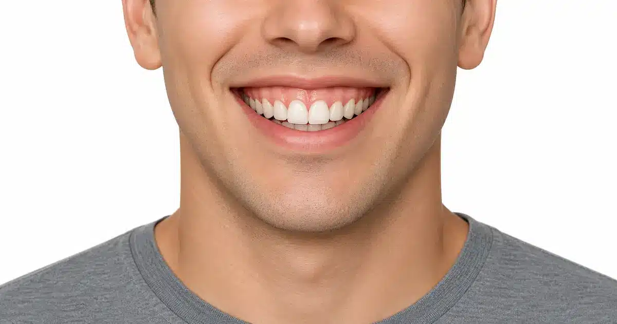 Sonrisa con encía visible al sonreír, ejemplo de sonrisa gingival