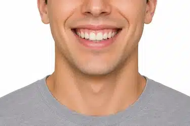Sonrisa con exposición moderada de encía al sonreír en los incisivos superiores