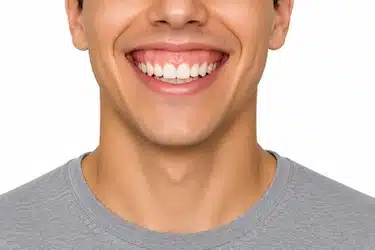 Sonrisa con alta exposición de encía al sonreír en los incisivos superiores