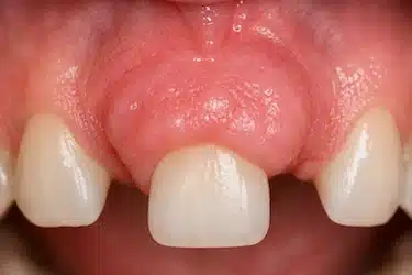 Encía superior con crecimiento gingival excesivo sobre el diente