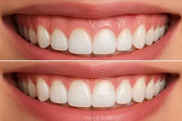 Gingivectomía estética para mejorar la proporción de la sonrisa