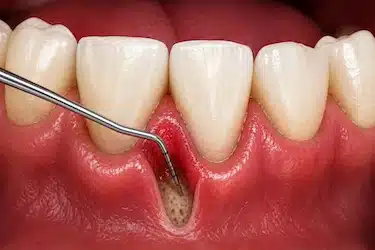 Gingivectomía periodontal para tratar bolsas en la encía
