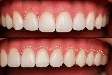 Gingivectomía por pieza o por cuadrante según la zona tratada
