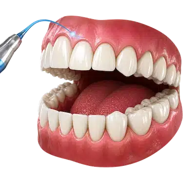 Láser dental retirando exceso de encía en una gingivectomía