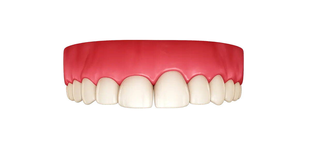 Tratamiento de gingivectomía para retirar exceso de encía